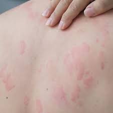 Image result for Papular urticaria