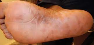 Guidance for medical providers and laboratories in california 2013, 15 p. Don T Forget About Syphilis Mdedge Dermatology