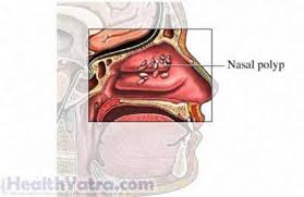 What are the basic treatment options? Nasal Polyp Definition Causes Symptoms Complications And Cost Surgery Treatment Hospital In India