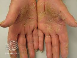 Image result for psoriasis
