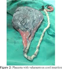 Velamentous and marginal insertion was associated with an increased risk of adverse outcomes such as placenta. Figure 2 From Velamentous Cord Insertion A Rare Cause Of Emergency Caesarean Section Semantic Scholar