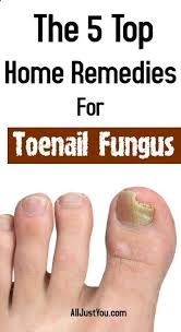 The 5 Top Most Home Remedies For Toenail Fungus Toenail Fungus Beauty Nail Infection Hair Health Nail Fungus Treatment Nail Fungus Remedy Toenail Fungus