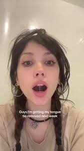 ‼️ كيف تعرف إذا عندك هي العقدة (Tongue Tie)👅؟- صعوبة رفع اللسان إلى  الأسنان العلوية أو تحريكه من جانب إلى آخر- صعوبة إخراج اللسان إلى ما بعد  الأسنان الأمامية السفلية- لسان يبدو مجوفًا أو على شكل قلب ...