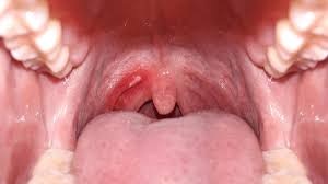 Image result for Labial mucosa