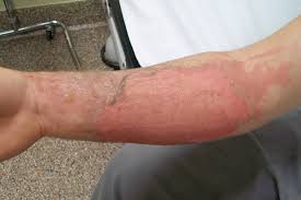 When that happens, the skin layers start to separate, which leads to. Burns Clinical Advisor