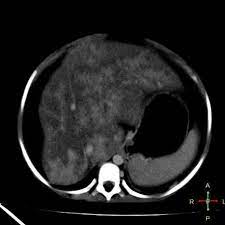 Budd Chiari Syndrome Radiology Reference Article Radiopaedia Org