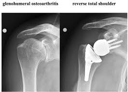 Shoulder Arthritis | University Orthopedics