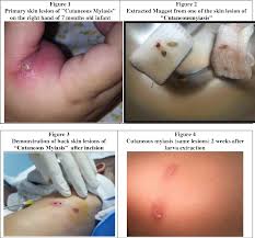 Myiasis is the medical term for infestation of living tissues of humans and vertebrates by fly larvae. Cutaneous Myiasis In Saudi Infant A Rare Case Report Semantic Scholar