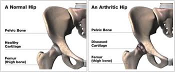 Ligaments are the structures that bind bones together. Hip Joint Anatomy Hip Bones Ligaments Muscles