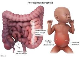 Image result for Allergic Colitis of Infancy