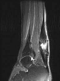 Mri Scan Of A Patient With Chronic Tendinopathy Of The Main Body Of The Download Scientific Diagram