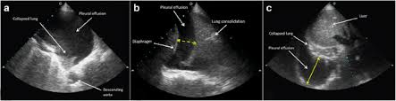 Chest ultrasound to evaluate pleural effusion. Thoracic Ultrasound For Pleural Effusion In The Intensive Care Unit A Narrative Review From Diagnosis To Treatment Critical Care Full Text