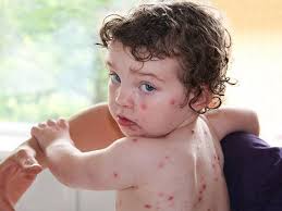 Q. Which condition is caused by Varicella-Zoster Virus (HHV-3)? A.Oral  herpes B.Genital herpes C.Chickenpox D. Keratoconjunctivitis