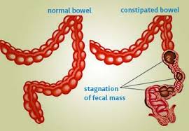 Image result for Chronic Constipation