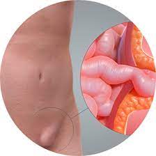 Hernias Da Parede Abdominal Doutor Fernando Figueiredo