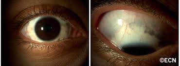 Image result for melanosis sclera