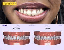 You are here :» how to get pain free.» i was worried about getting braces for my 7 year old, since it seemed like he was too young for it. Hidden Camera Investigation Finds Misleading Information Questionable Treatment Plans From Smiledirectclub Cbc News