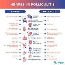 Image result for genital herpes