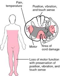 Anterior Cord Syndrome Spinal Cord Spinal Cord Injury Physical Therapist Assistant