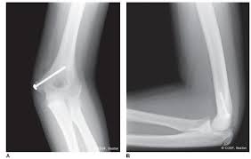Medial epicondyle fractures are much more common than medial condyle fractures. The Thrower S Elbow Obgyn Key