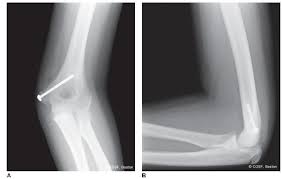 Quizlet is the easiest way to study, practise and master what you're learning. The Thrower S Elbow Obgyn Key