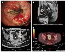 Colon cancer can spread to the liver through a blood vessel that connects the intestines and liver. Local Advanced Rectal Cancer Perforation In The Midst Of Preoperative Chemoradiotherapy A Case Report And Literature Review