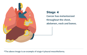 lung cancer can sometimes be mistaken for a rare form of cancer known as pleural mesothelioma.mesothelioma is similar to lung cancer in that it develops in the lungs, but different in that tumors will metastasize (grow) in the lining of the lungs or the pericardium, instead of within the lungs themselves. Stage 4 Mesothelioma Prognosis Treatment Life Expectancy