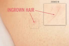 Come summertime, many people turn to bikini waxes for hair removal. How To Prevent Ingrown Hairs Best Tips Body Scrubs Exfoliating Gloves