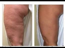 Como Eliminar La Celulitis De Las Piernas Y Gluteos Rapidamente Como Eliminar La Celulitis De Las Piernas Y Gluteos Rapidamente Celulitis Piernas Eliminar Celulitis Como Eliminar Las Celulitis