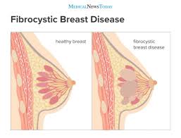 A painless lump or thickening in your breast tissue. Fibrocystic Breast Disease Causes Symptoms And Treatment