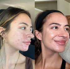 JENNY BRANHAM • ACNE SKINCARE SPECIALIST (@acnespecialistokc) • Instagram  photos and videos