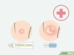 Most ingrown hairs go away on their own in about a month. How To Get Rid Of Ingrown Pubic Hair With Pictures Wikihow