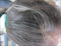 It sends your body into survival mode, so your body channels oxygen to support vital functions as opposed to ones like keeping your hair intact, explains moritz. Indian Journal Of Dermatology Venereology And Leprology Premature Graying Of Hair