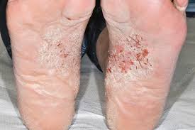 Image result for Pustular Psoriasis