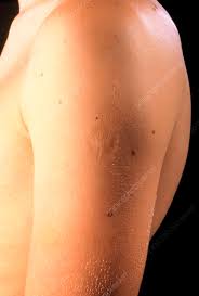 Smallpox vaccination scar - Stock Image - M715/0351 - Science Photo Library