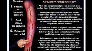 Image result for Compartment Syndrome