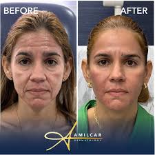 Los rostros de mis pacientes son un canvas perfecto para yo crear un arte  que respete su anatomía y su armonía facial ☺️. No hay mayor satisfacción  que lograr que una paciente