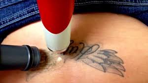 The most trusted name in tattoo removal in houston, texas. Laser Tattoo Removal Cost Per Session