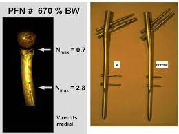 Abbildung 4 19 Femur V Rechts Pfn 670 Bw Abbildung 4 19 Zeigt Das Download Scientific Diagram