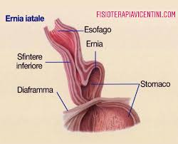 Buongiorno, ho un labrador maschio di 2 anni del peso di 30/35 kg a cui è stata riscontrata, fin dalla nascita, un'ernia iatale. Ernia Iatale E Reflusso Gastro Esofageo Tagmedicina Giornale Medico On Line Salute Benessere Prevenzione E Aggiornamenti Del Settore Medico