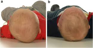 Image result for Positional Head Deformity