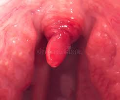 Image result for Uvulitis