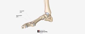 Pin On The Bunion Cure