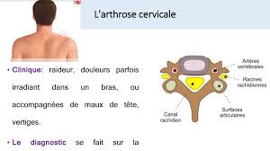 Pour la plupart des gens, l'arthrose cervicale ne provoque aucun symptôme. Pathologies Rachidiennes Ppt Telecharger
