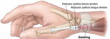 Finkelstein's test is the classic provocative test for diagnosis of de quervain's disease. De Quervain S Tenosynovitis Effective Diagnosis And Evidence Based Treatment Intechopen
