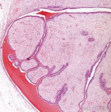 I just remember flicking through a gallery of photos of different people's chests. What Do Breast Cancer Lumps Feel Like With Pictures
