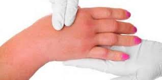 Ari Alerjisi Belirtileri Ve Tedavisi