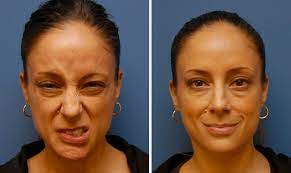 It begins suddenly and worsens over 48 hours. Bell S Palsy Facial Exercises The Facial Paralysis Institute