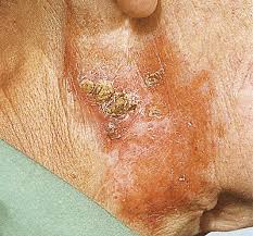 Tuberculosis cutis luposa (lupus vulgaris) enlarge all figures a painful area of partly indurated and squamous erythema with an irregular border was seen on his right arm. Lupus Vulgaris Gesundheit De