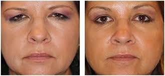 While depending upon a range of factors, the minimum cost for forehead / brow lift in turkey is usd 2500. Brow Lift And Open Eye Look Botox Injection Botox Botox Eyebrow Lift